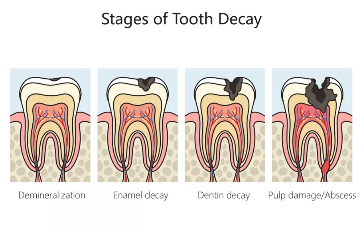 Stages of Tooth Decay